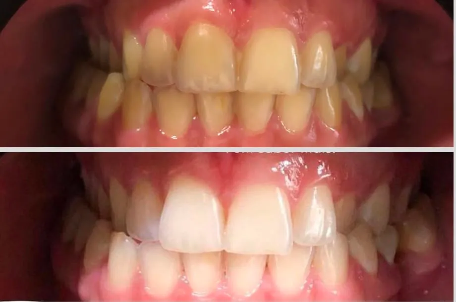 Clareamento Dental Estético Supervisionado - Clínica Isiortho