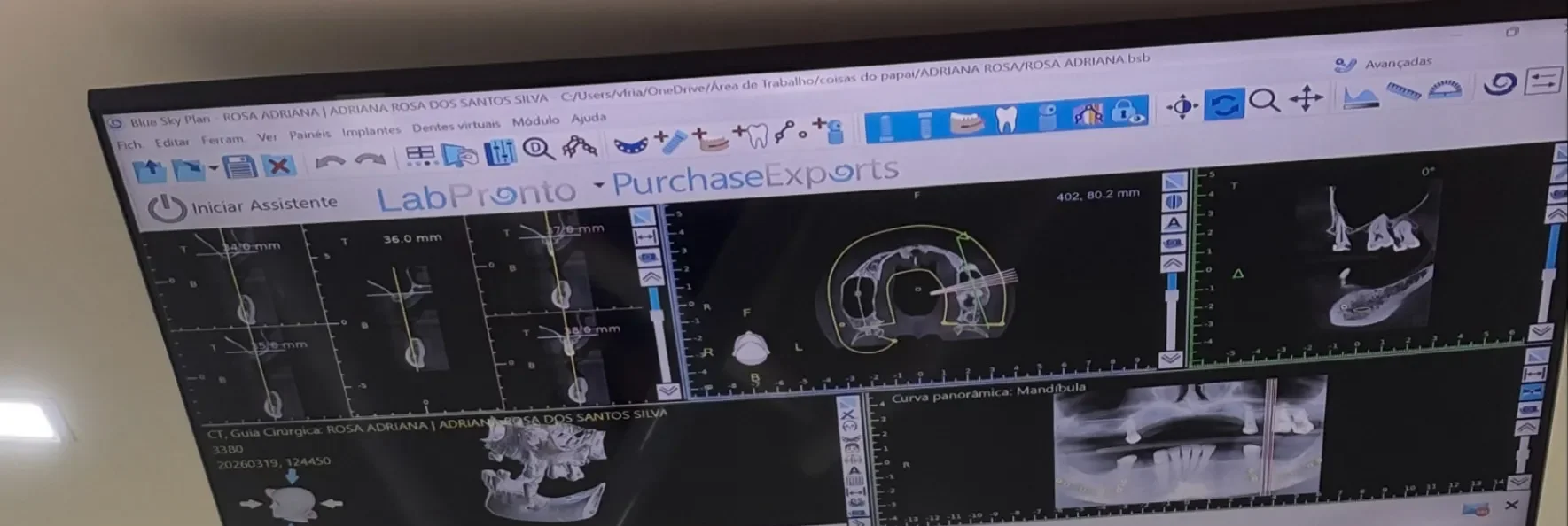 Planejamento digital de Implante Dentário com cirurgia guiada - Clínica Isiortho